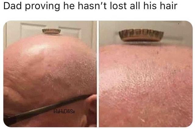 Minoxidil, the Shedding Phase, and Why Reddit Isn't the Enemy (Just Loud)